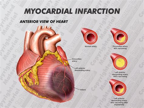 myocardial infarction causes